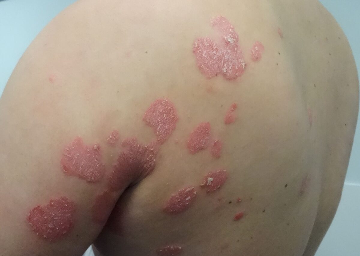 Psoriasis vulgaris – Neue Leitlinie 2025