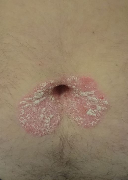 Psoriasis Leitlinie 2025 –Was ist neu, was ist wichtig?