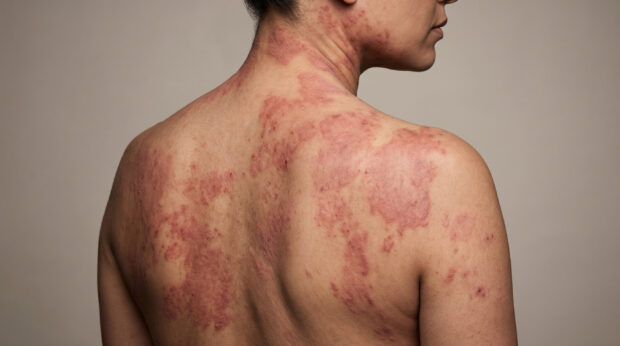 Neue Therapiekonzepte bei Atopischer Dermatitis 