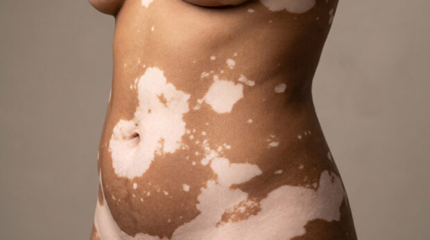 Vitiligo – State of the Art 2026